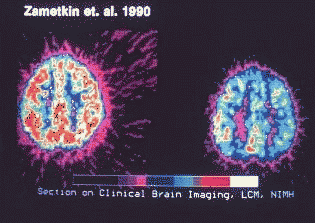 Zametkin's brain scan images from NIMH publication on Attention Deficit Hyperactivity Disorder